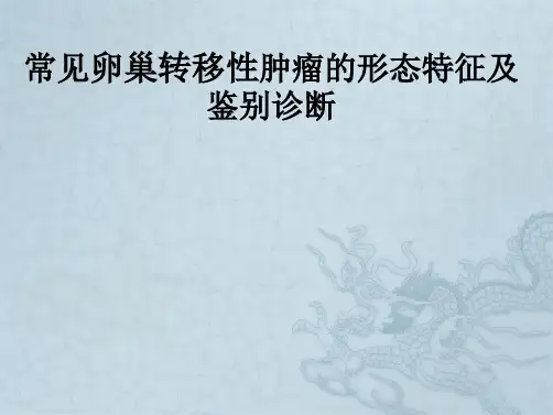 常见卵巢转移性肿瘤形态特征及鉴别诊断