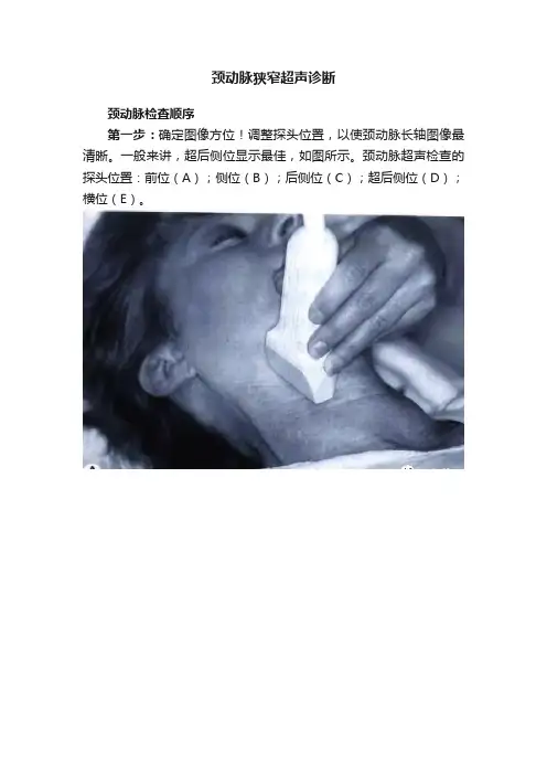 颈动脉狭窄超声诊断