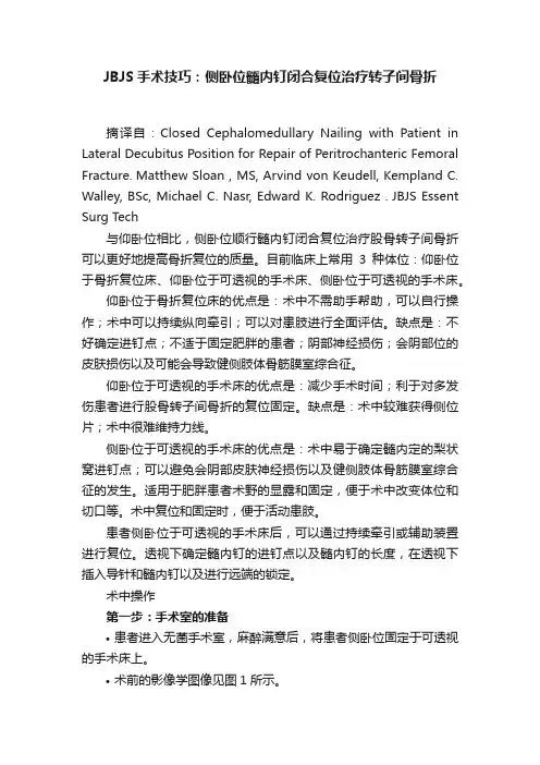 JBJS手术技巧：侧卧位髓内钉闭合复位治疗转子间骨折