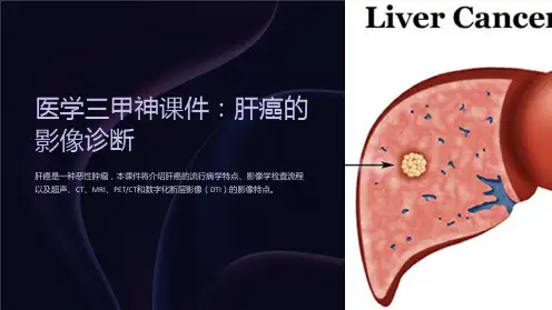 医学三甲神课件：肝癌的影像诊断