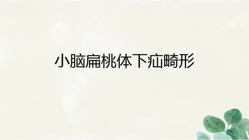 小脑扁桃体下疝畸形