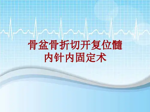 手术讲解模板：骨盆骨折切开复位髓内针内固定术