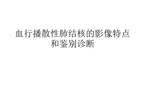 血行播散性肺结核的影像特点和鉴别诊断