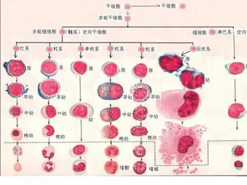 慢性粒细胞白血病