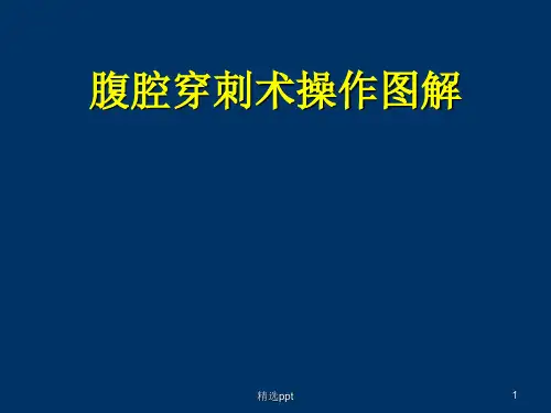 腹腔穿刺术操作图解