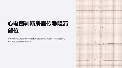心电图判断房室传导阻滞部位