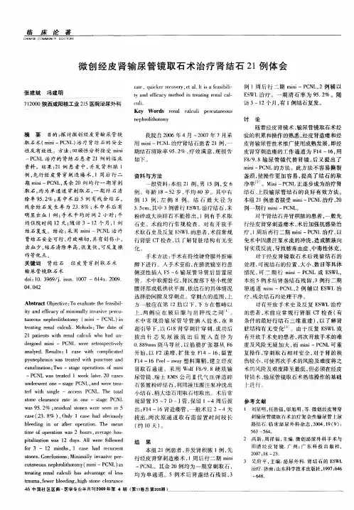 微创经皮肾输尿管镜取石术治疗肾结石21例体会