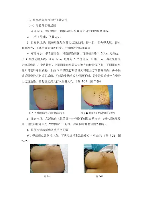 内热针布针方法（二）