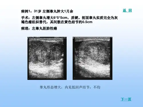 睾丸病例