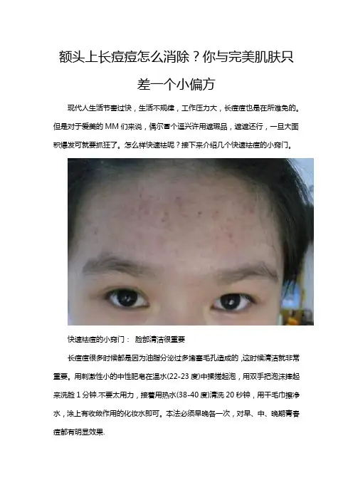 额头上长痘痘怎么消除？你与完美肌肤只差一个小偏方