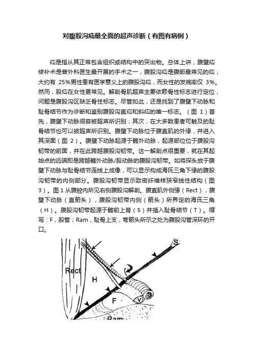 对腹股沟疝最全面的超声诊断（有图有病例）