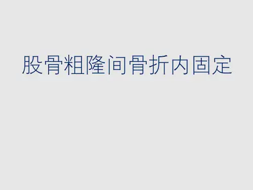 股骨粗隆间骨折内固定