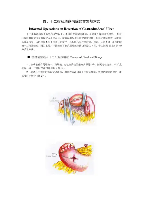 手术图谱资料：胃、十二指肠溃疡切除的非常规术式