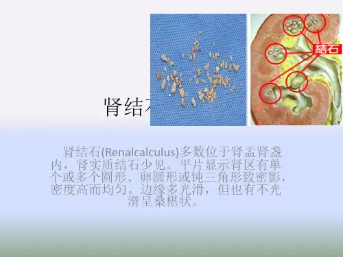 肾结石(肾石病)PPT