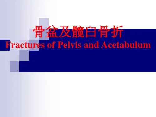 骨盆及髋臼骨折ppt课件
