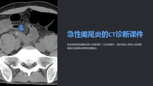 急性阑尾炎的CT诊断课件