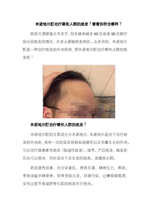米诺地尔酊治疗哪些人群的脱发？看看你符合哪种？