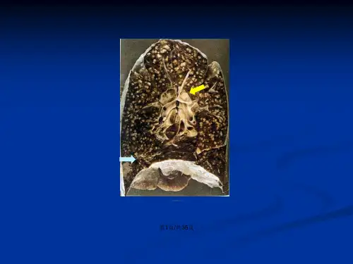 基础医学病理切片图片大全Gross