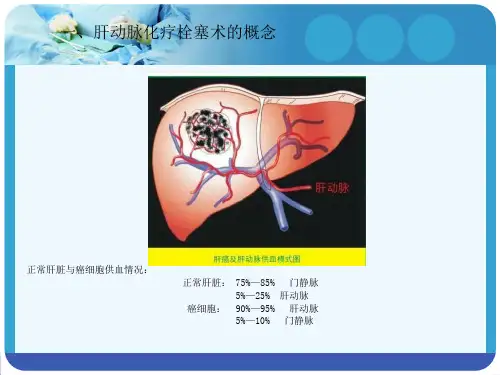肝动脉化疗栓塞术