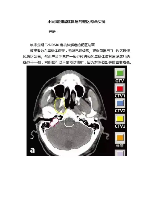 不同期别扁桃体癌的靶区勾画实例