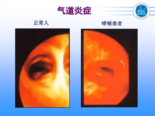2019-1哮喘诊断和分级-文档资料