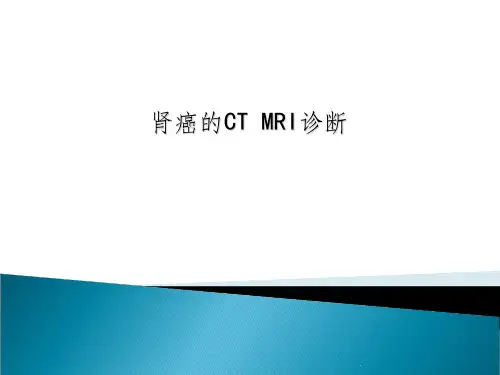 肾癌的CT磁共振诊断