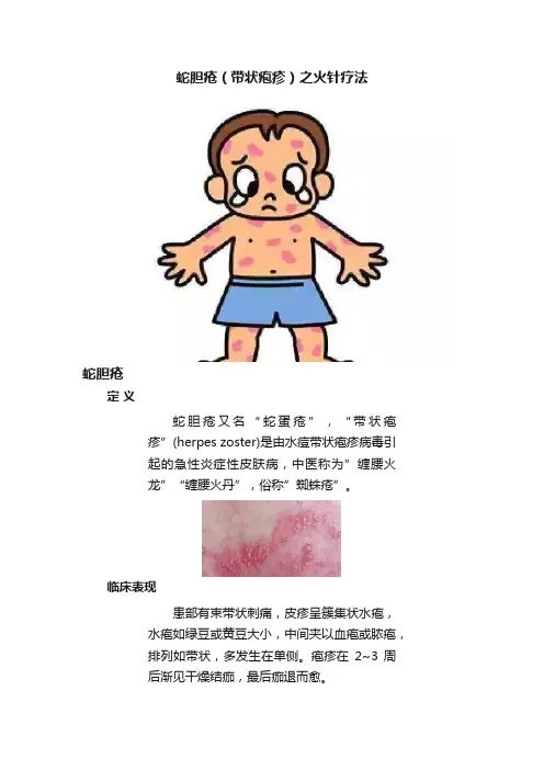 蛇胆疮（带状疱疹）之火针疗法