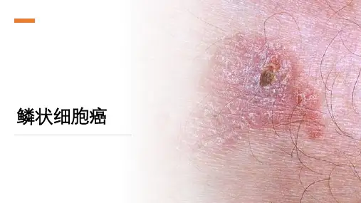 鳞状细胞癌