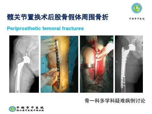 髋关节置换术后股骨假体周围骨折PPT课件