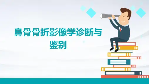 鼻骨骨折影像学诊断与鉴别