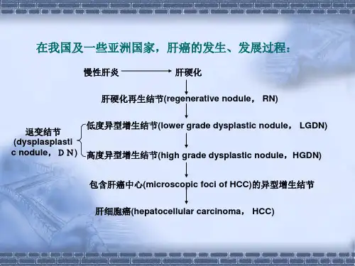 肝硬化结节向肝癌转化的病理与影像表现
