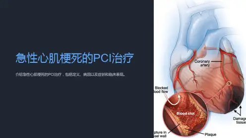 急性心肌梗死的PCI治疗