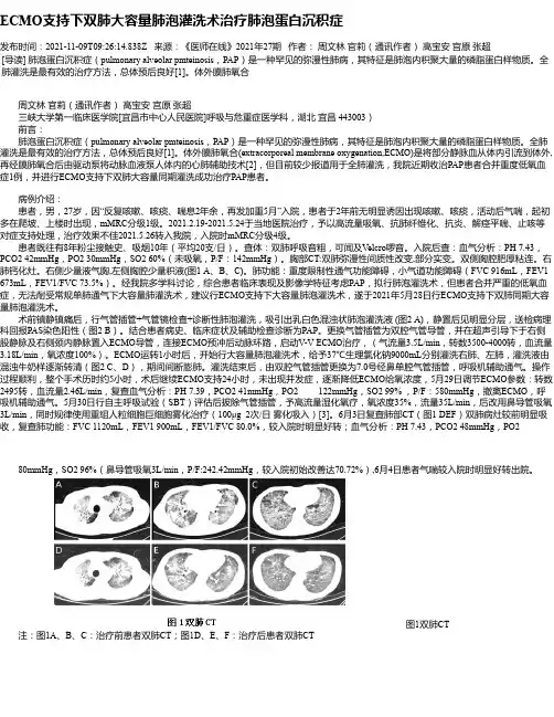 ECMO支持下双肺大容量肺泡灌洗术治疗肺泡蛋白沉积症