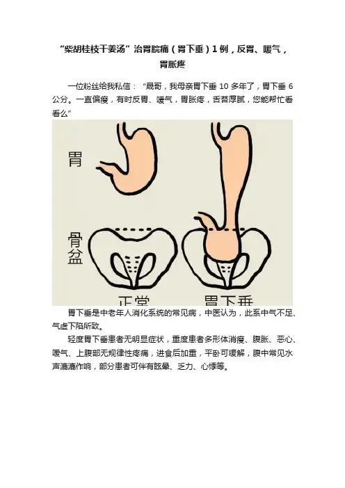“柴胡桂枝干姜汤”治胃脘痛（胃下垂）1例，反胃、喛气，胃胀疼
