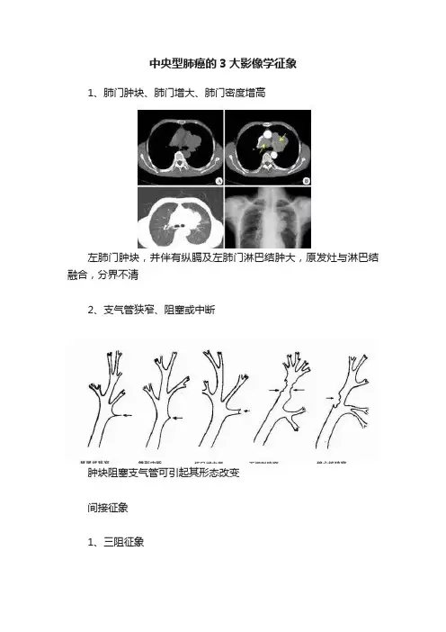中央型肺癌的3大影像学征象