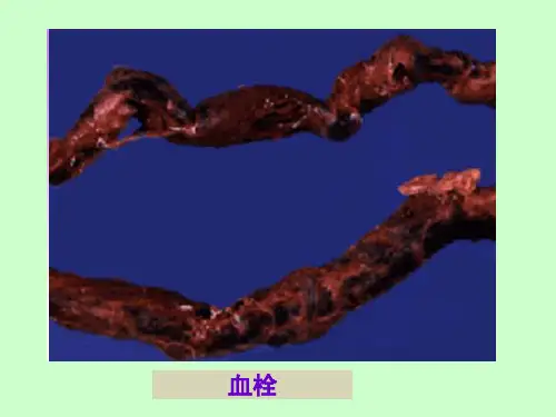 病理学4(栓塞-炎症)