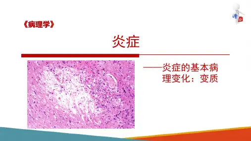 炎症的基本病理变化—变质(病理学课件)