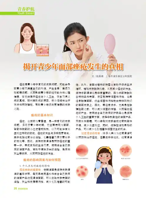揭开青少年面部痤疮发生的真相