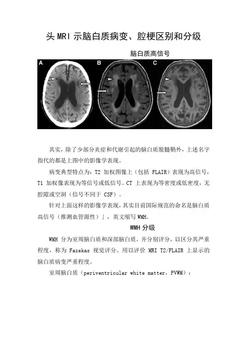 头MRI示脑白质病变、腔梗区别和分级