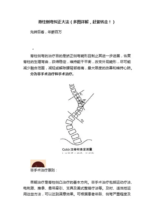 脊柱侧弯纠正大法（多图详解，赶紧转走！）