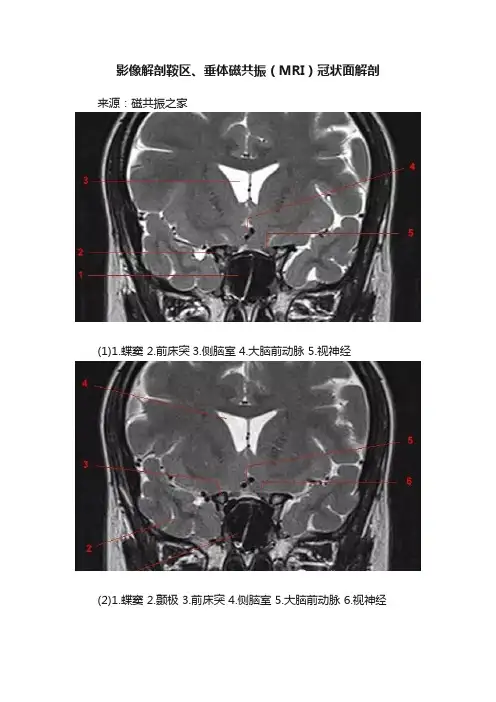 影像解剖鞍区、垂体磁共振（MRI）冠状面解剖