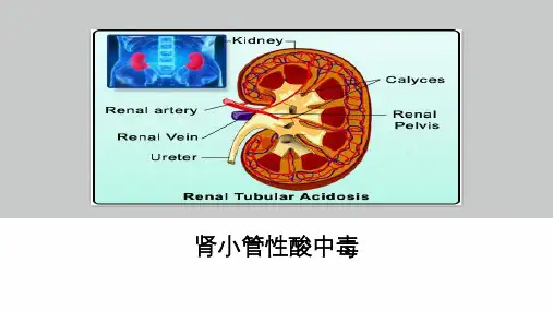 肾小管性酸中毒。