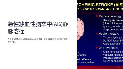 急性缺血性脑卒中(AIS)静脉溶栓