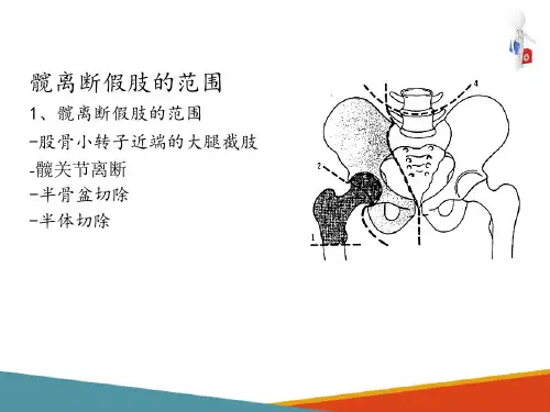 下肢假肢—下肢假肢的结构特点
