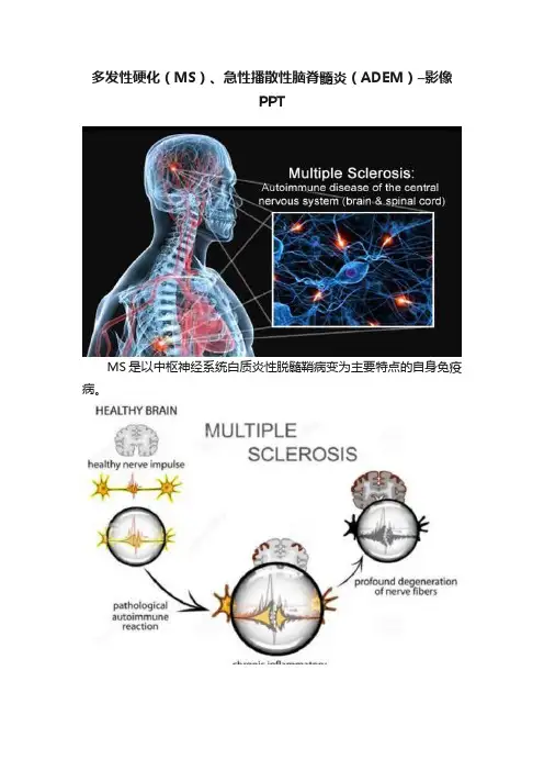 多发性硬化（MS）、急性播散性脑脊髓炎（ADEM）–影像PPT