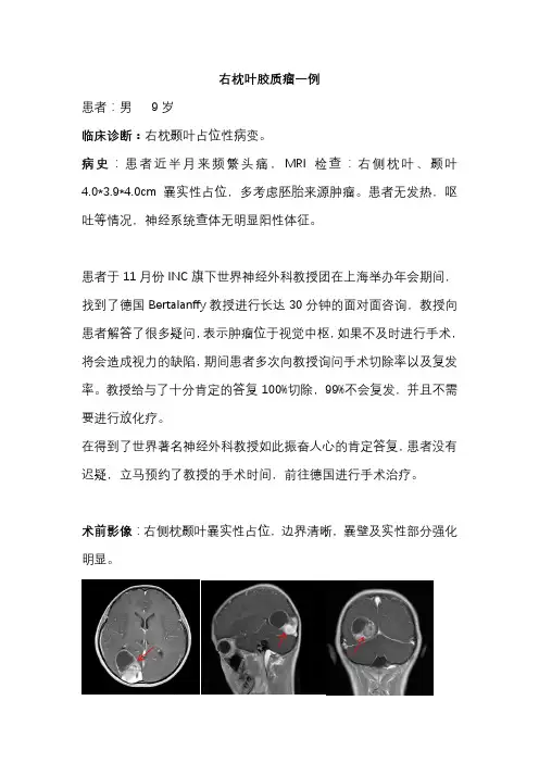 右侧枕颞叶胶质瘤