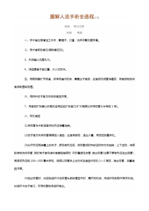 图解人流手术全进程