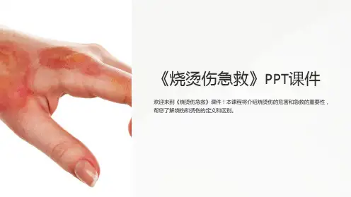 《烧烫伤急救》课件