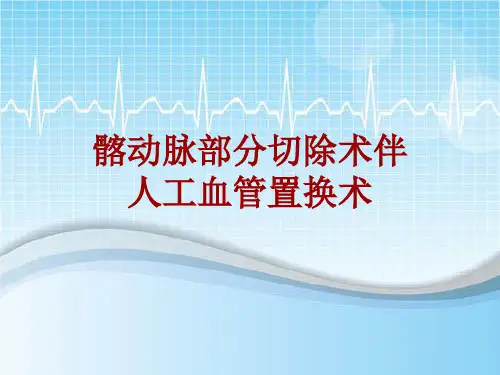 手术讲解模板：髂动脉部分切除术伴人工血管置换术