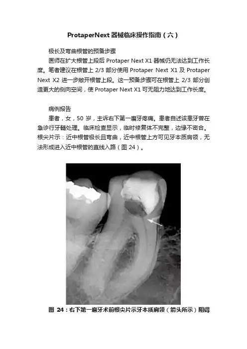 ProtaperNext器械临床操作指南（六）